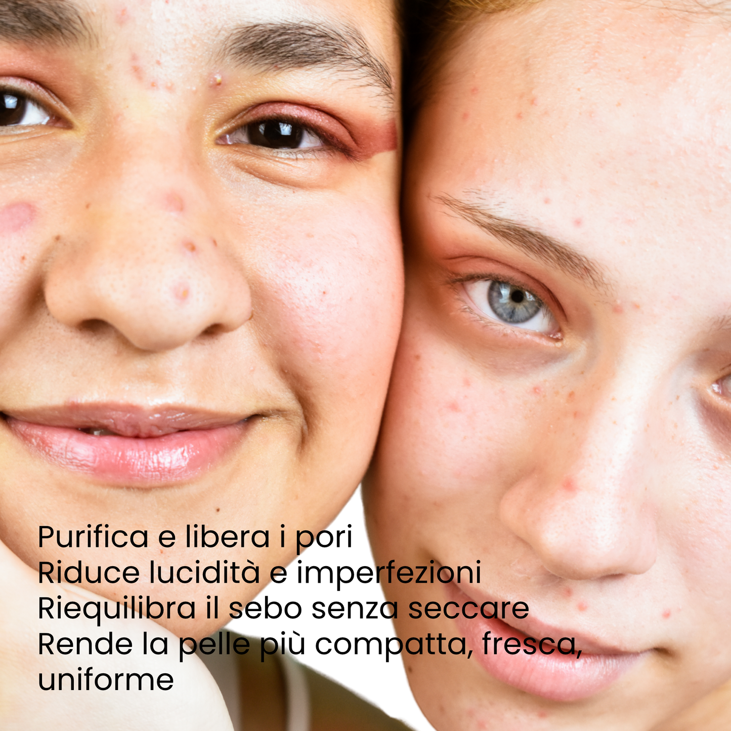 Detox Skin Kit - Trattamento Completo Anti-Acne